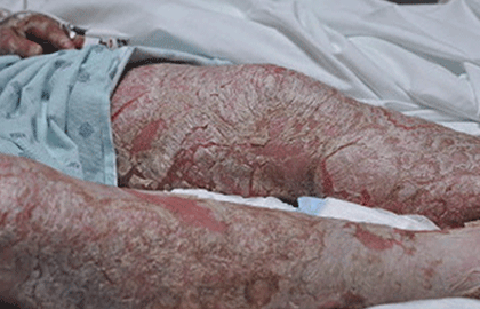 Generalized pustular psoriasis