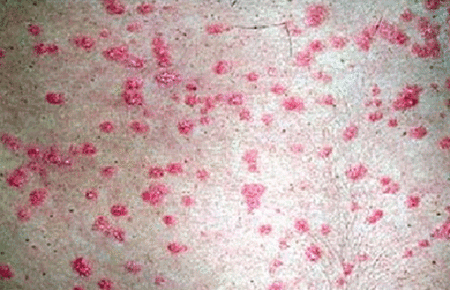 Guttate psoriasis