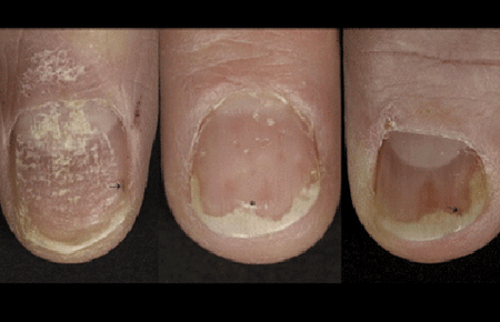 Nail psoriasis