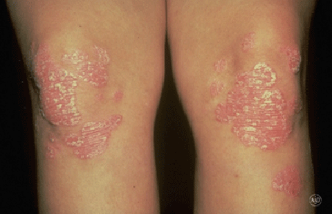 Plaque psoriasis on knees