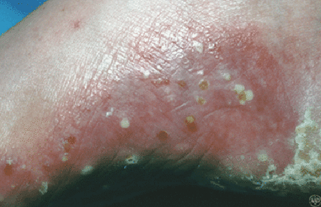 Pustular psoriasis