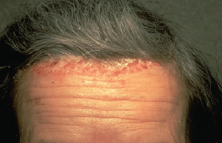 scalp psoriasis