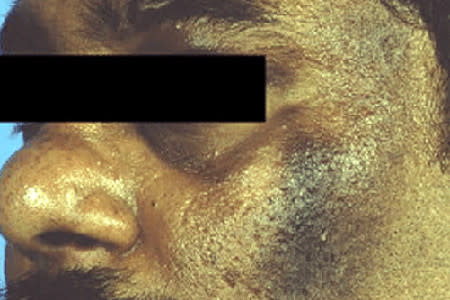 Obese man with acanthosis nigricans on his face