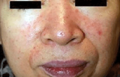 Woman with papulopustular rosacea