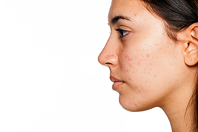 Woman with acne