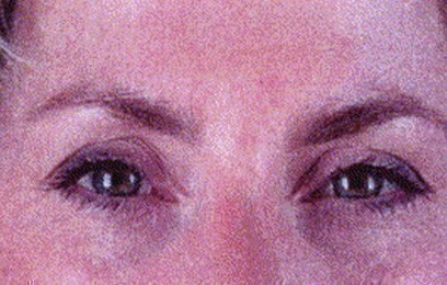 Patient after botulinum toxin treatment