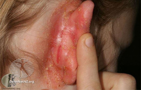 Atopic dermatitis behind woman's ear