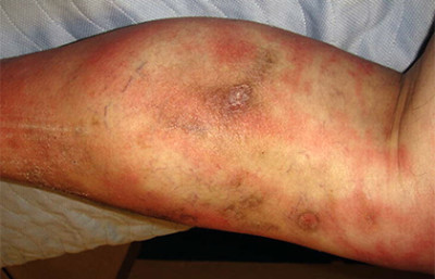 Cellulitis on the lower leg