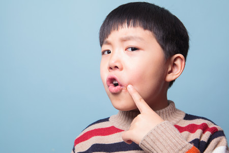 A child pointing at a cold sore on his face