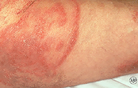 Cutaneious T-cell lymphoma often looks like a rash