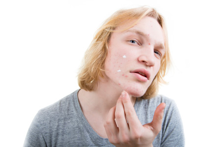 young man treating pimples on face