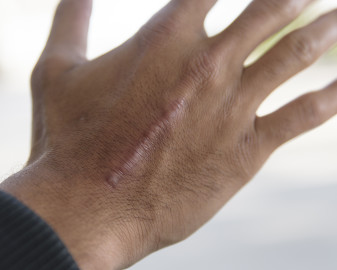 Keloid scar on the back of the hand of an African American man.