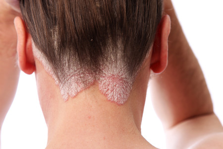 Scalp psoriasis extended to back of neck and behind ears