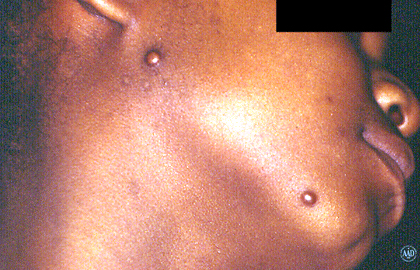 Two keloid scars on a girl's jawline