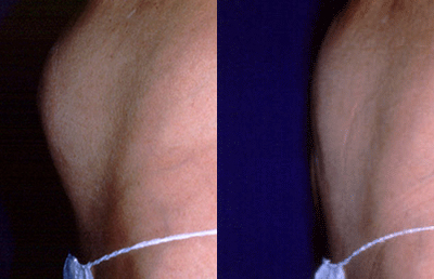 Before and after tumescent liposuction