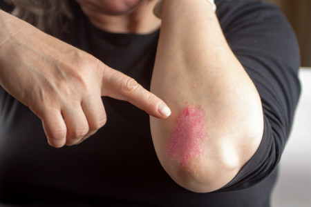 psoriasis on elbow