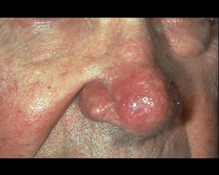 rosacea on nose