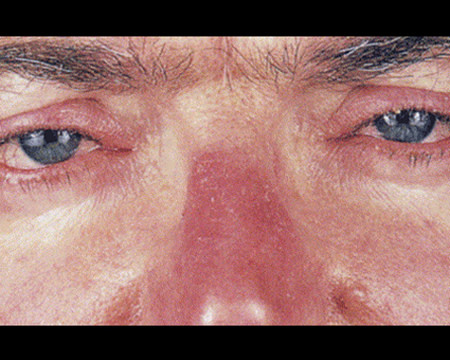 man with rosacea on nose and eyes