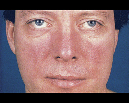 rosacea on man's face