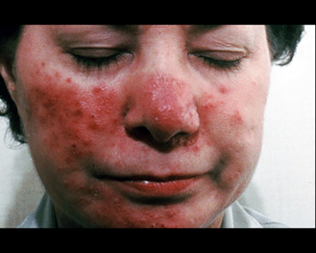 rosacea on woman's face