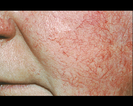 rosacea on cheek