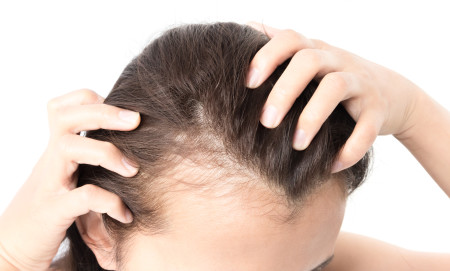 woman showing receding hairline