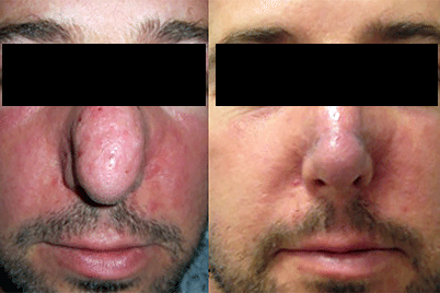 before and after rosacea treatment