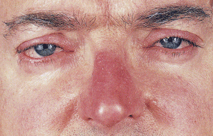 Man with rosacea on eyes and nose