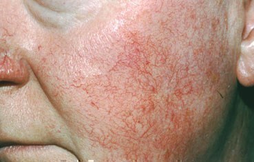 Woman with rosacea subtype 1