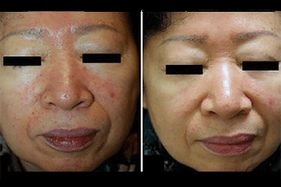 woman with rosacea