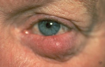 Ocular rosacea