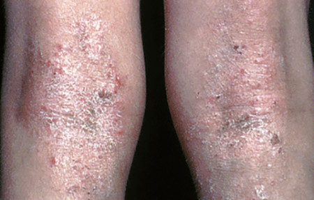 severe atopic dermatitis knees