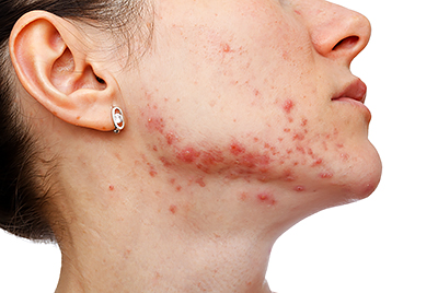 Woman with acne along jaw line