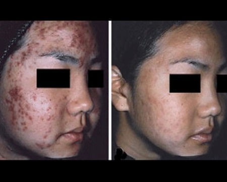 Before and after acne treatment