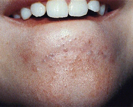 Blackheads and whiteheads