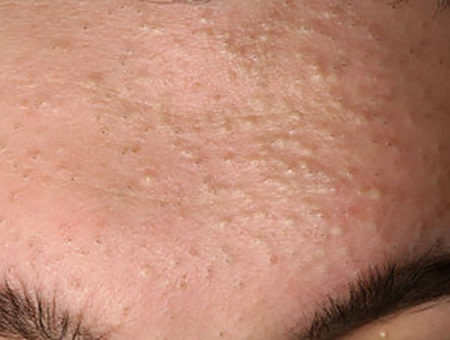 woman's forehead with whiteheads