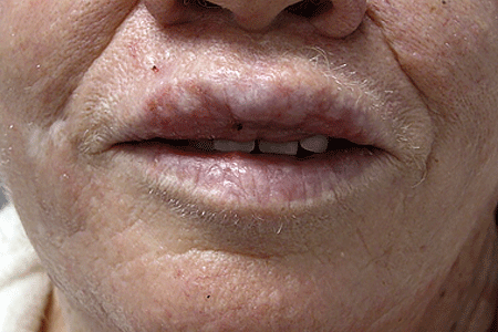 White patches on this man's lips could be a sign of a precancerous skin condition called actinic keratosis