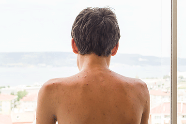 man with back acne