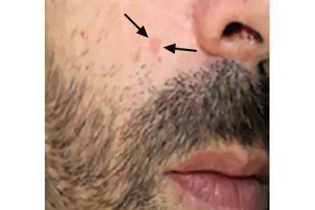 Close-up of basal cell carcinoma on patient's cheek that was mistaken for an age spot