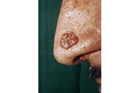 Close-up of basal cell carcinoma on a patient's nose