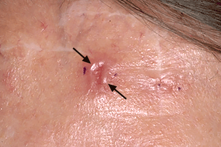 A group of shiny bumps on a patient's skin is basal cell carcinoma