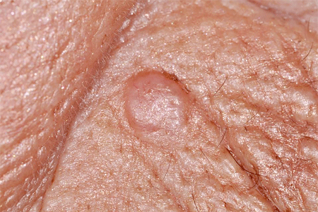 Round growth on patient's face is basal cell carcinoma