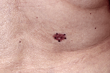 Basal cell carcinoma on a patient's body may look like a scaly patch with a spot of normal-looking skin in the center