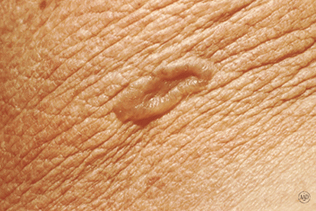 Close-up of basal cell carcinoma on elderly woman's skin could be mistaken for a scar