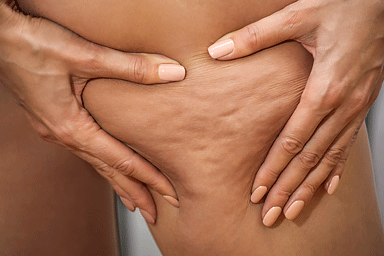 Woman pushing the skin of her leg to show cellulite