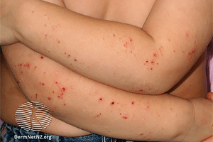 Child with atopic dermatitis