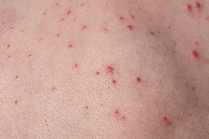 Folliculitis on child's back