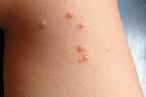 Child with molluscum contagiosum