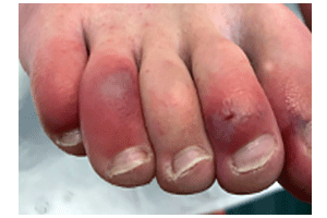 Patient with COVID toes