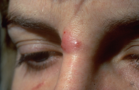 acne cyst on woman's face